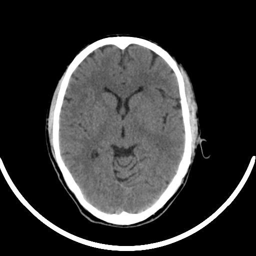 Chronic invasive fungal sinusitis with intraorbital and intracranial extension (Radiopaedia 56387-63046 Axial non-contrast 195).jpg