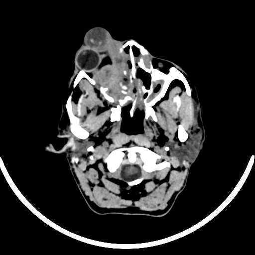 File:Chronic invasive fungal sinusitis with intraorbital and intracranial extension (Radiopaedia 56387-63046 Axial non-contrast 82).jpg