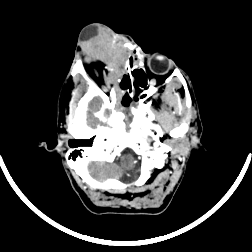 Chronic invasive fungal sinusitis with intraorbital and intracranial extension (Radiopaedia 56387-63046 B 83).jpg