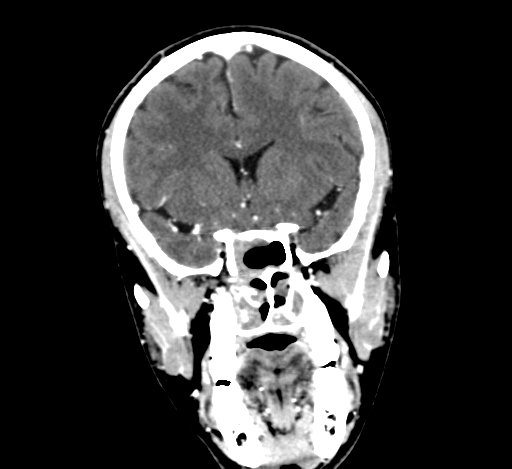 Chronic invasive fungal sinusitis with intraorbital and intracranial extension (Radiopaedia 56387-63046 C 154).jpg