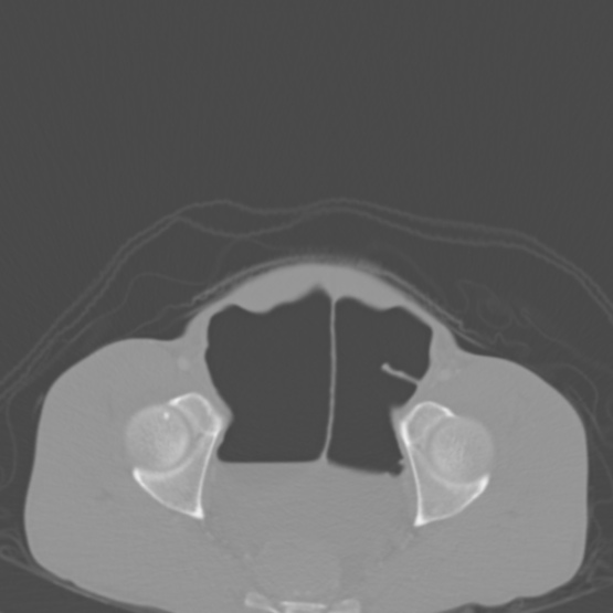 Chronic large bowel pseudo-obstruction (Radiopaedia 43181-46492 Axial bone window 151).jpg