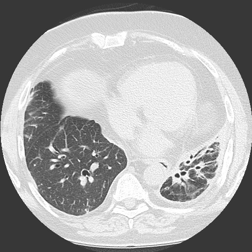Chronic lung allograft dysfunction - restrictive form (Radiopaedia 60595-68316 Axial lung window 48).jpg