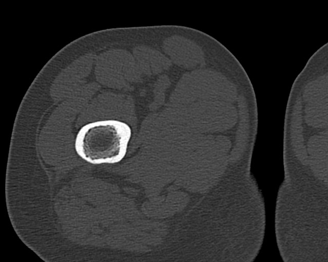 Chronic ostemyelitis of the femur with long sinus tract (Radiopaedia 74947-85982 Axial bone window 35).jpg
