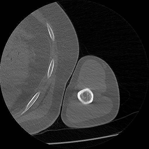 File:Chronic osteomyelitis (Radiopaedia 67597-76998 Axial bone window 36).jpg