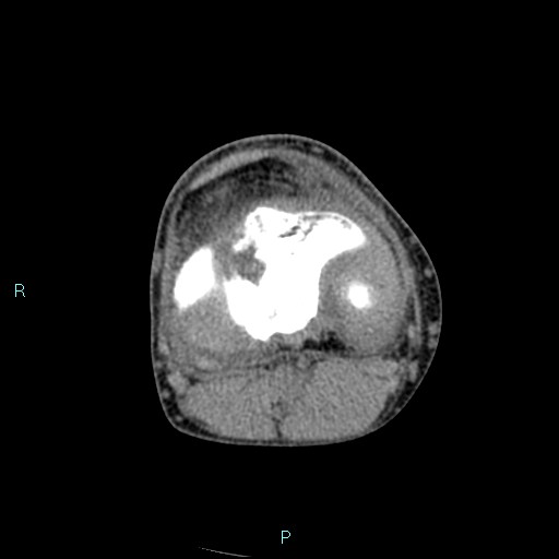 Chronic osteomyelitis (with Brodie abscess) (Radiopaedia 76405-88111 A 109).jpg