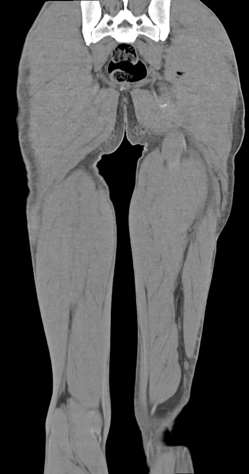 Chronic osteomyelitis (with sequestrum) (Radiopaedia 74813-85822 E 46).jpg