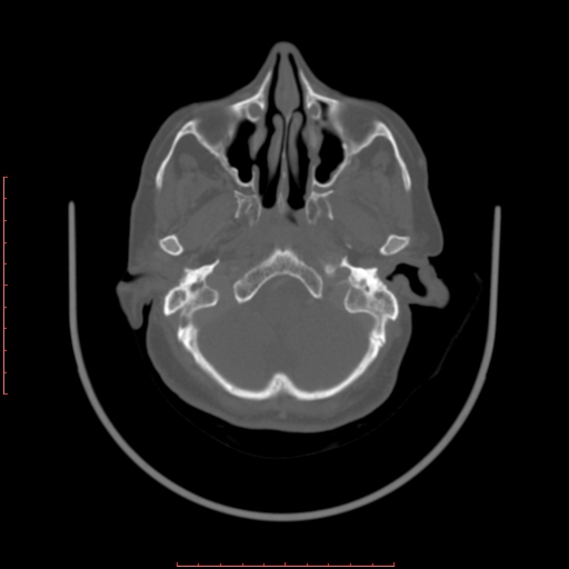 Chronic osteomyelitis - maxilla (Radiopaedia 23783-23927 Axial bone window 115).jpg