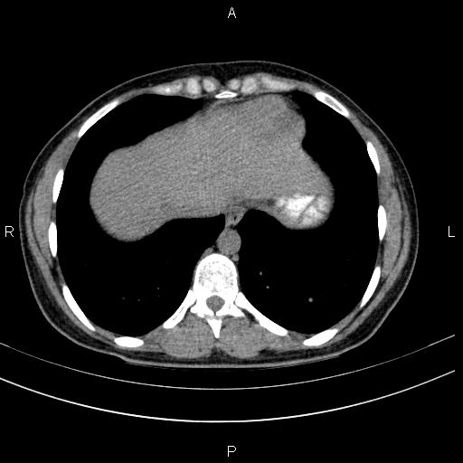 Chronic pancreatitis (Radiopaedia 64576-73450 Axial non-contrast 5).jpg