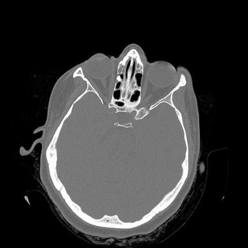 Chronic sinusitis with intra-sinus calcification (Radiopaedia 63919-72668 Axial bone window 9).jpg