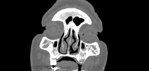 Chronic sphenoidal sinusitis (Radiopaedia 62030-70122 Coronal bone window 22).jpg