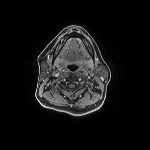 Chronic submandibular sialadenitis (Radiopaedia 61852-69885 Axial T1 C+ fat sat 63).jpg