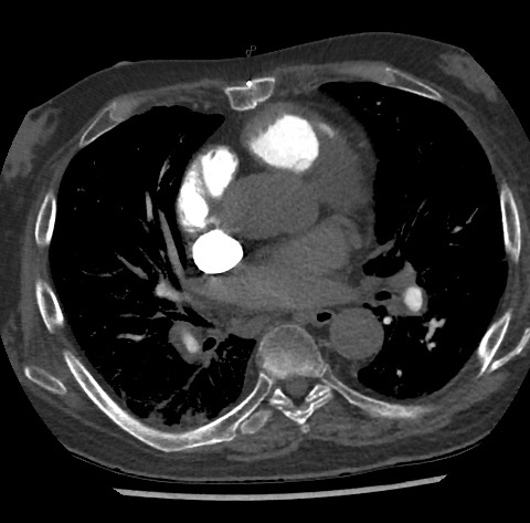 File:Chronic thromboembolic pulmonary disease (Radiopaedia 90694-108119 Axial C+ CTPA 54).jpg