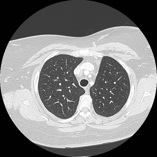 Cicatrisation collapse (Radiopaedia 17405-17089 lung window 30).jpg