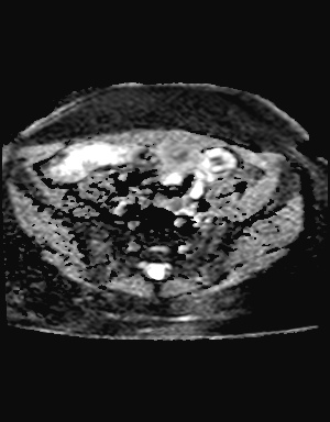 File:Class II Mullerian duct anomaly- unicornuate uterus with rudimentary horn and non-communicating cavity (Radiopaedia 39441-41755 Axial ADC 6).jpg