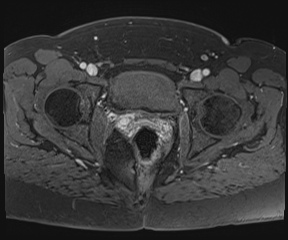 File:Class II Mullerian duct anomaly- unicornuate uterus with rudimentary horn and non-communicating cavity (Radiopaedia 39441-41755 Axial T1 fat sat 103).jpg