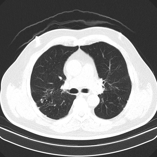 Classic complicated silicosis (Radiopaedia 49720-54961 Axial lung window 23).jpg