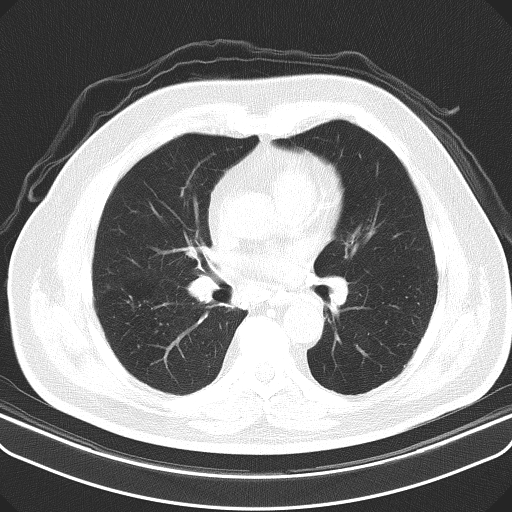 Classic complicated silicosis (Radiopaedia 49720-54961 Axial lung window 29).jpg