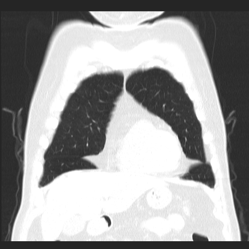File:Classic complicated silicosis (Radiopaedia 49720-54961 Coronal lung window 12).jpg