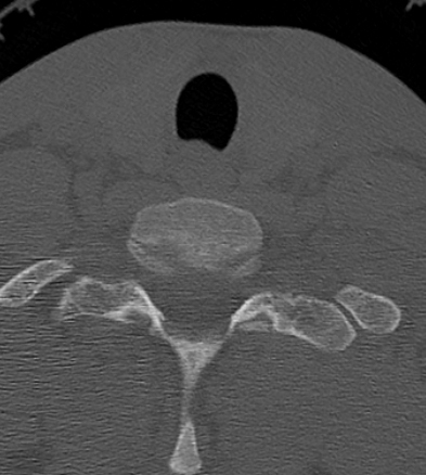 Clay-shoveler fracture (Radiopaedia 14604-14532 Axial bone window 49).jpg