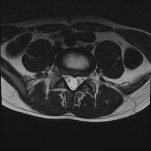 File:Clear cell meningoma - lumbar spine (Radiopaedia 60116-67690 Axial T2 11).png