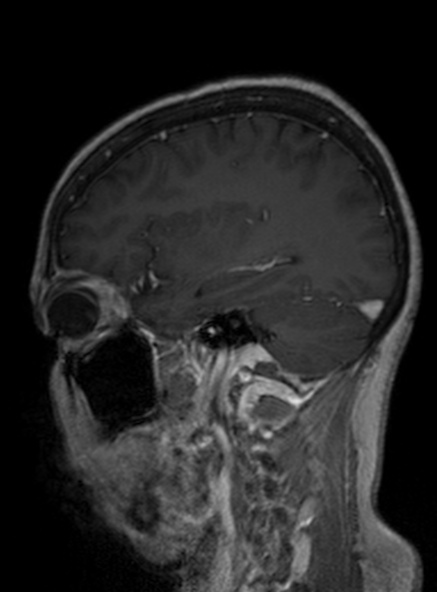 Clival meningioma (Radiopaedia 53278-59248 Sagittal T1 C+ 197).jpg