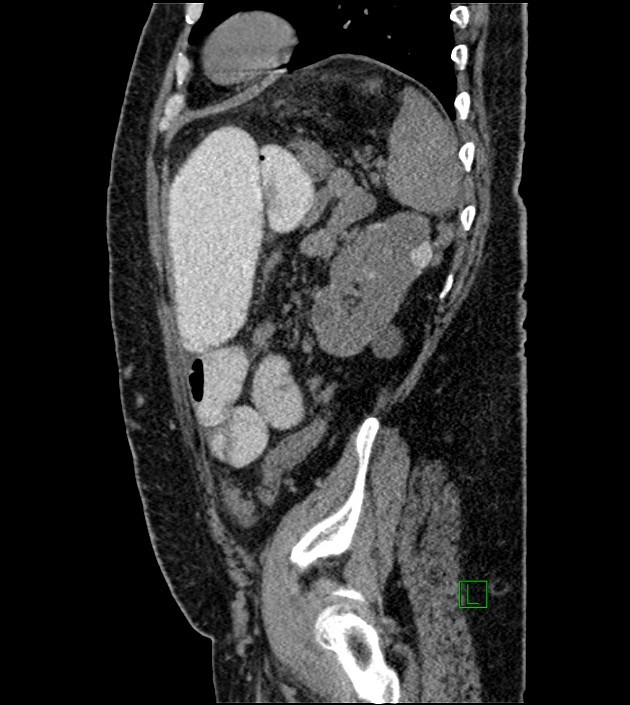 Closed-loop small bowel obstruction-internal hernia (Radiopaedia 78439-91096 C 42).jpg