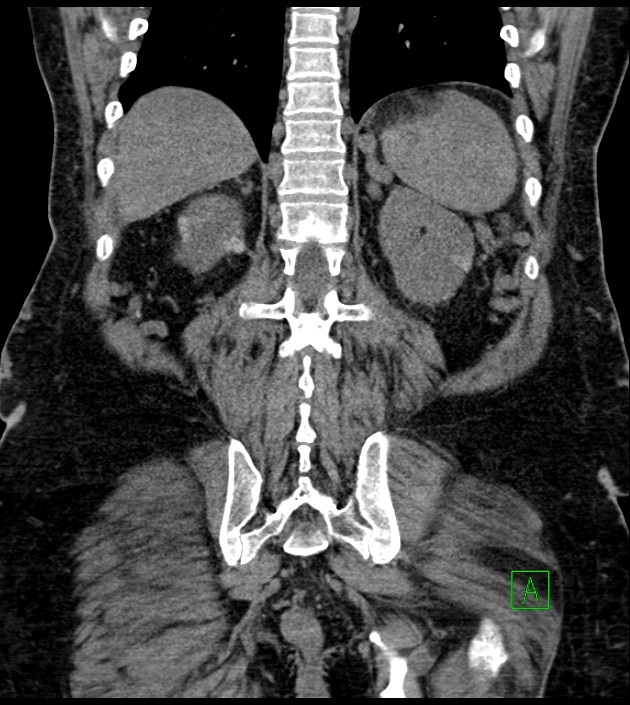Closed-loop small bowel obstruction-internal hernia (Radiopaedia 78439-91096 Coronal non-contrast 78).jpg