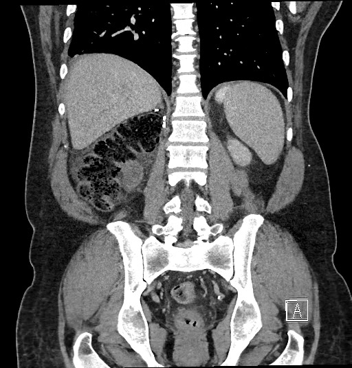 Closed loop obstruction - internal hernia into nephrectomy bed (Radiopaedia 59867-67320 B 100).jpg