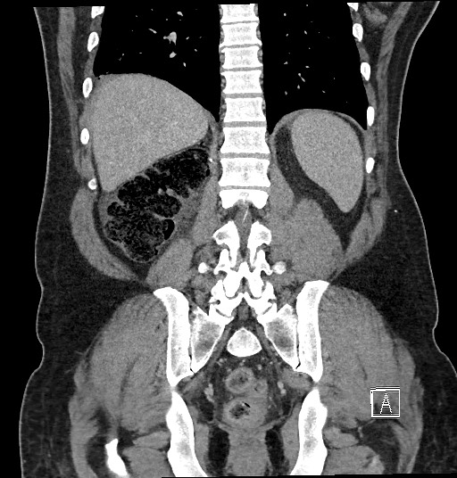 Closed loop obstruction - internal hernia into nephrectomy bed (Radiopaedia 59867-67320 B 105).jpg