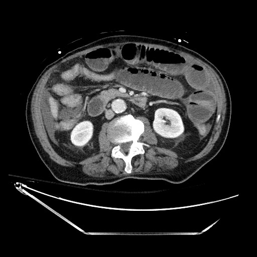 Closed loop obstruction due to adhesive band, resulting in small bowel ischemia and resection (Radiopaedia 83835-99023 D 72).jpg