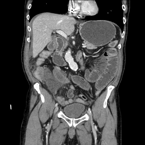 Closed loop obstruction due to adhesive band, resulting in small bowel ischemia and resection (Radiopaedia 83835-99023 E 59).jpg