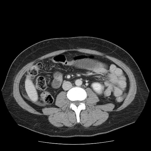 File:Closed loop small bowel obstruction (Radiopaedia 65403-74451 A 42).jpg