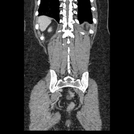 Closed loop small bowel obstruction (Radiopaedia 65403-74451 B 86).jpg
