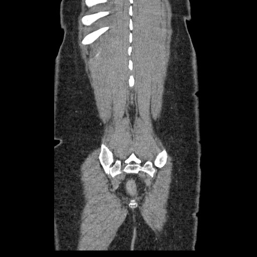 File:Closed loop small bowel obstruction (Radiopaedia 65403-74451 B 94).jpg