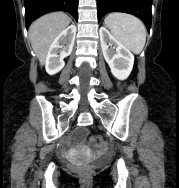 Closed loop small bowel obstruction (Radiopaedia 71211-81508 B 92).jpg