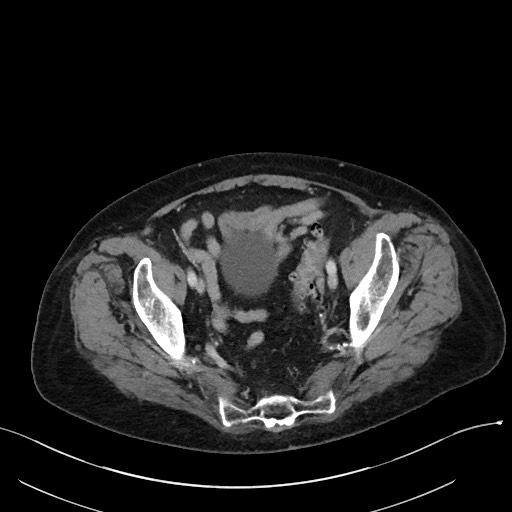 File:Closed loop small bowel obstruction - adhesions (Radiopaedia 59269-66611 A 109).jpg