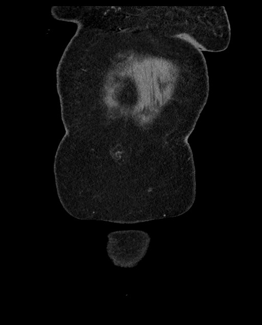 Closed loop small bowel obstruction - adhesions (Radiopaedia 59269-66611 B 12).jpg