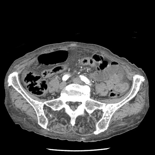 File:Closed loop small bowel obstruction - adhesions and infarct (Radiopaedia 85125-100678 A 120).jpg