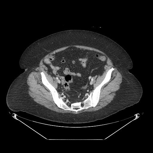Closed loop small bowel obstruction - internal hernia (Radiopaedia 65402-74450 A 105).jpg