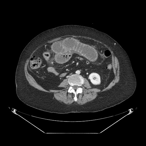 Closed loop small bowel obstruction - internal hernia (Radiopaedia 65402-74450 A 69).jpg
