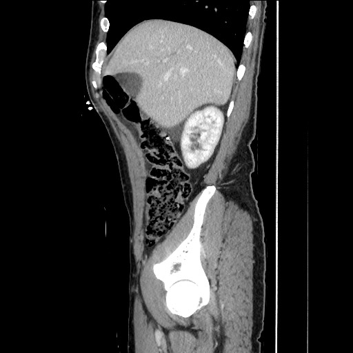 Closed loop small bowel obstruction - omental adhesion causing "internal hernia" (Radiopaedia 85129-100682 C 51).jpg