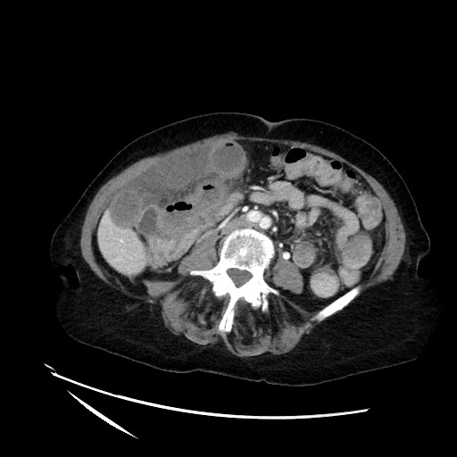 File:Closed loop small bowel obstruction due to adhesive band, with intramural hemorrhage and ischemia (Radiopaedia 83831-99017 Axial 3).jpg