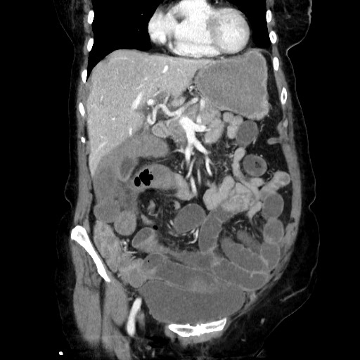 File:Closed loop small bowel obstruction due to adhesive band, with intramural hemorrhage and ischemia (Radiopaedia 83831-99017 C 46).jpg