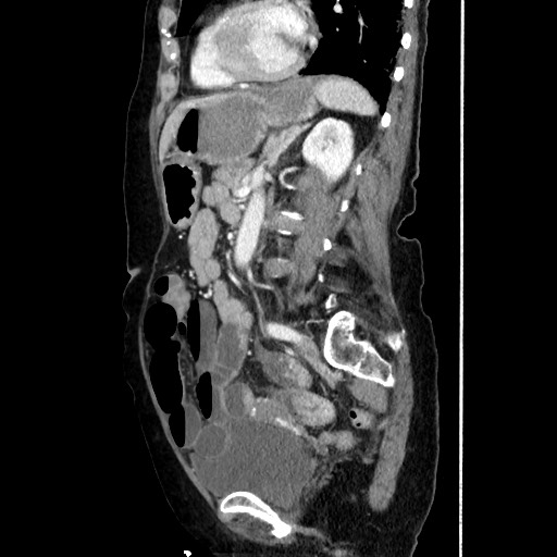 Closed loop small bowel obstruction due to adhesive band, with intramural hemorrhage and ischemia (Radiopaedia 83831-99017 D 120).jpg