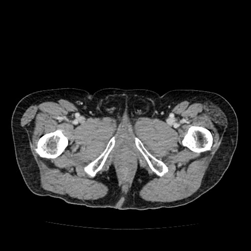 File:Closed loop small bowel obstruction due to adhesive band - U-shaped loop (Radiopaedia 83829-99012 A 77).jpg