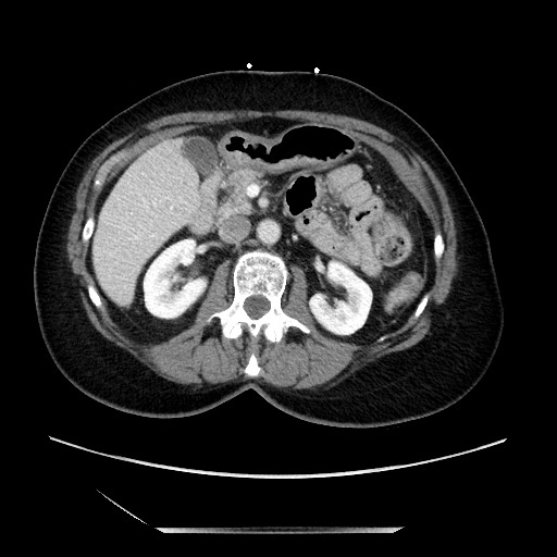 File:Closed loop small bowel obstruction due to adhesive bands - early and late images (Radiopaedia 83830-99014 A 52).jpg