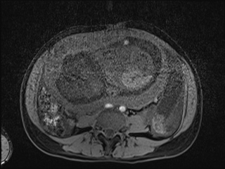 Closed loop small bowel obstruction in pregnancy (MRI) (Radiopaedia 87637-104031 F 15).jpg