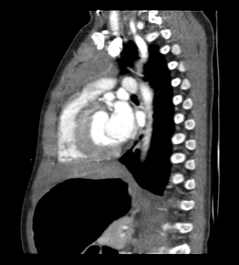 Coarctation of aorta (Radiopaedia 27427-27622 Sagittal C+ CTPA 81).png