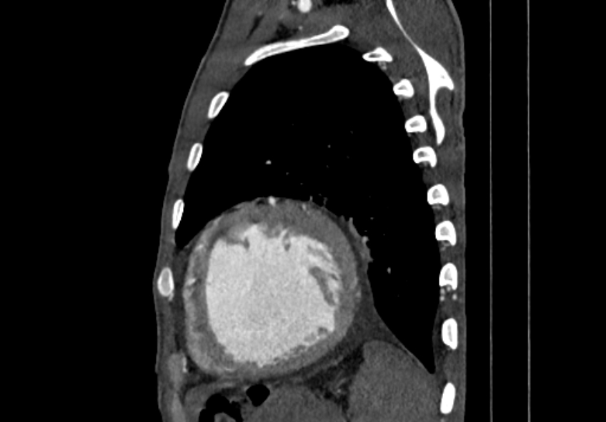 Coarctation of aorta with aortic valve stenosis (Radiopaedia 70463-80574 B 182).jpg