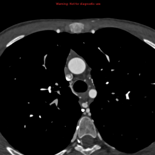 File:Coarctation of the aorta (Radiopaedia 12461-12697 A 107).jpg
